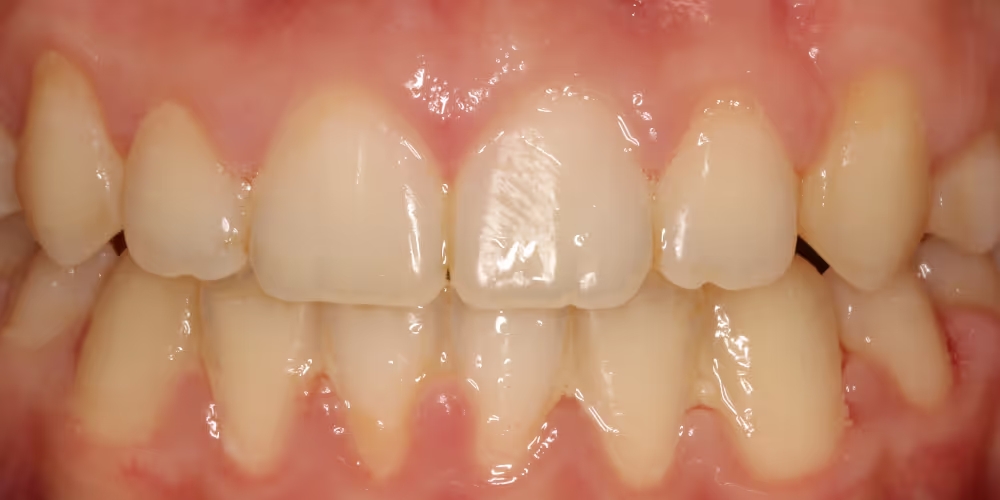 Teeth whitening solutions