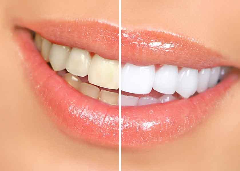 Teeth whitening solutions