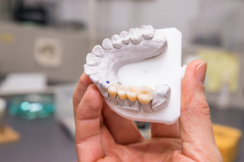 Dental-Bridges