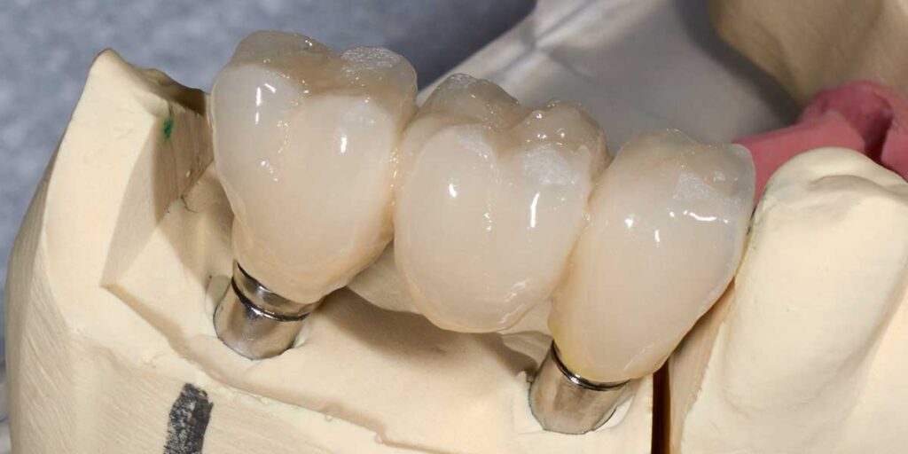 implant bridge for missing teeth treatment options