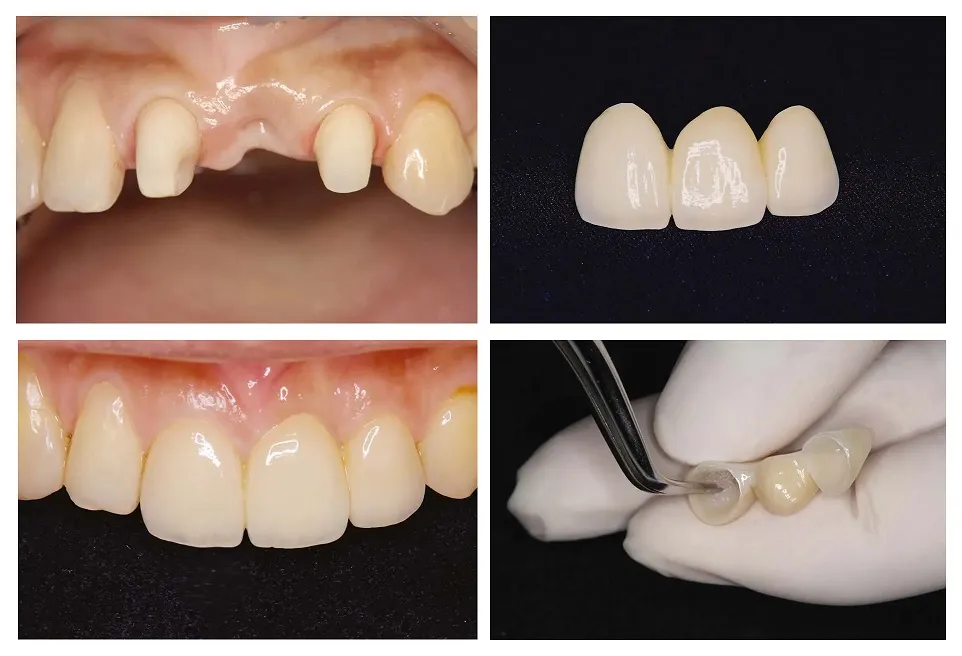 dental bridges