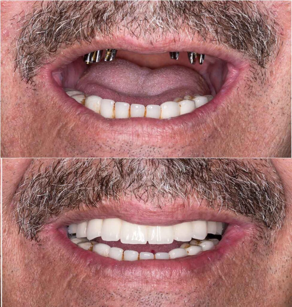 Which-Is-Best-for-You-Implants-vs.-Dentures