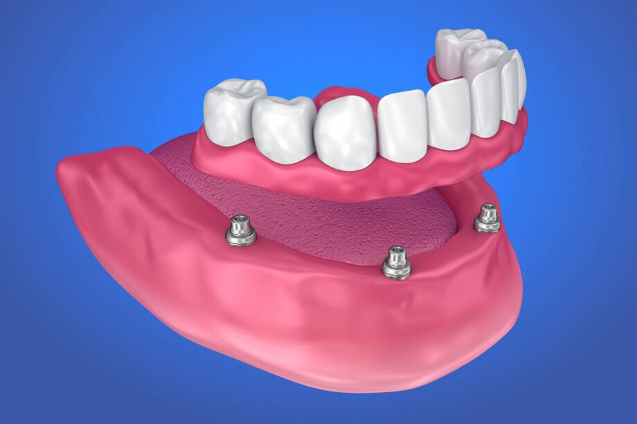all on four dental implants