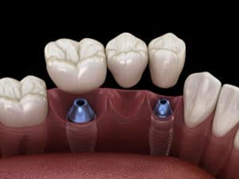 implant bridge for missing teeth treatment options