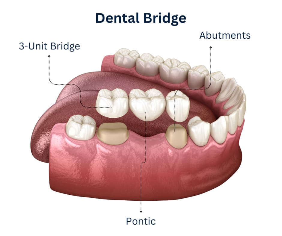 Dental-Bridges