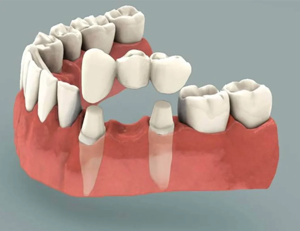 Dental-Bridges