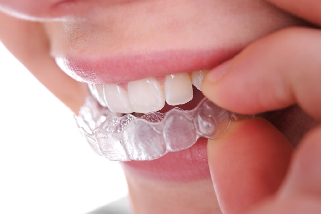 Invisalign - Clear Aligners