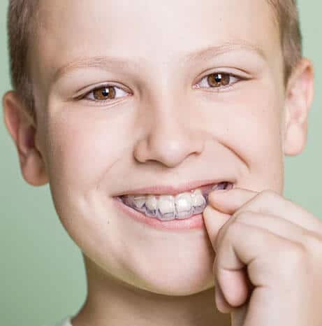 Invisalign - Clear Aligners