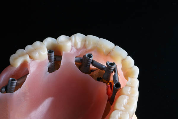 temporary prosthesis and supporting structure made of metal abutments