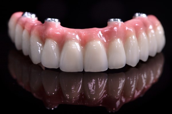 implant-supported-dentures