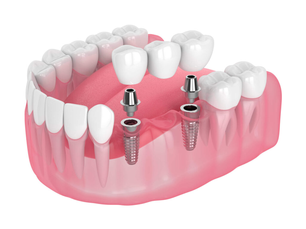 implant bridge for missing teeth treatment options