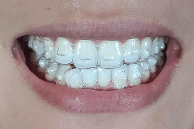 Clear Aligners