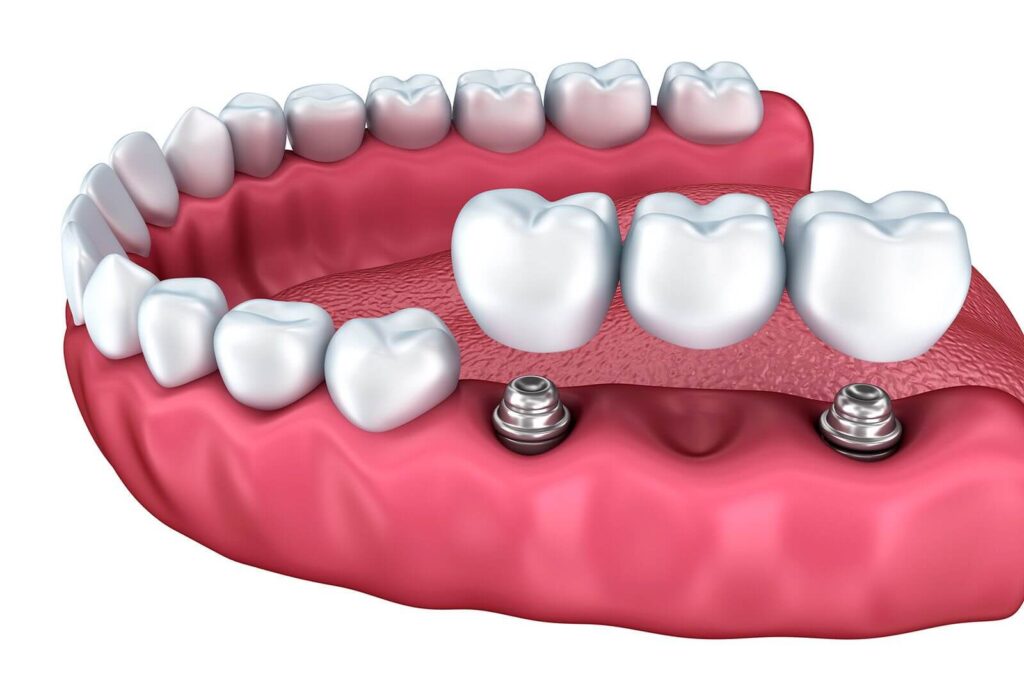 implant bridge for missing teeth treatment options