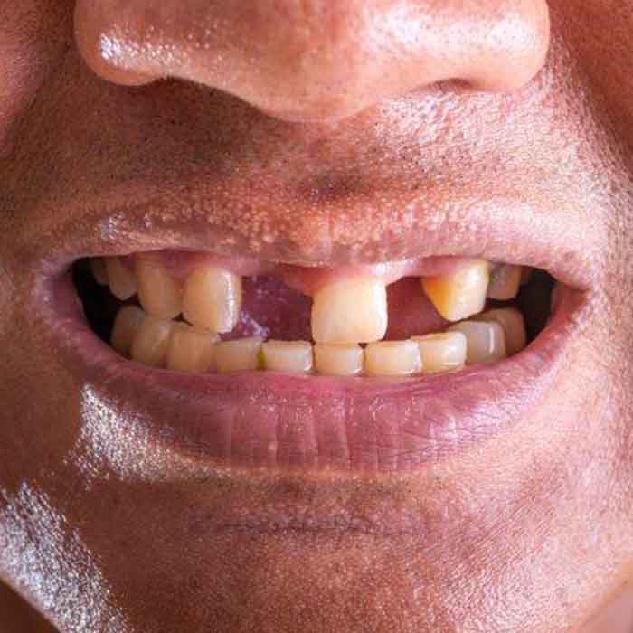 missing teeth