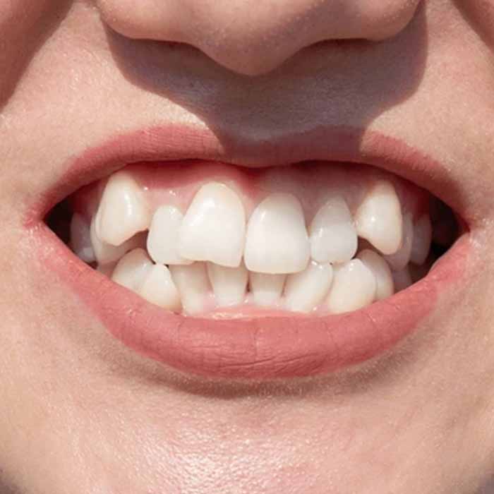 Crooked Teeth