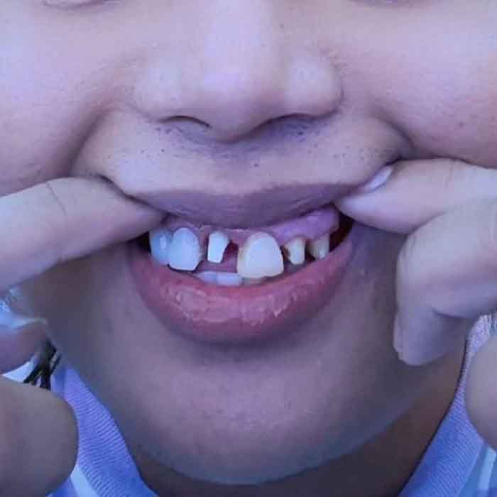 Crooked teeth with gaps