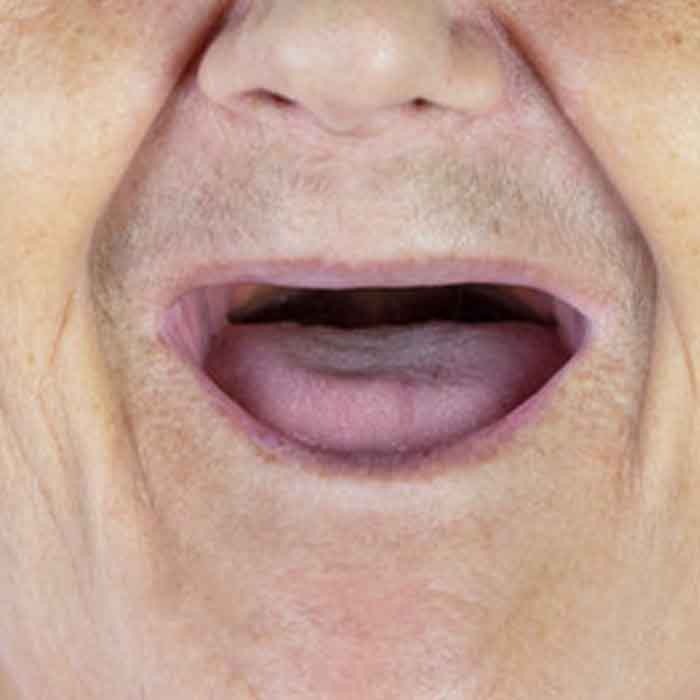 Missing all teeth