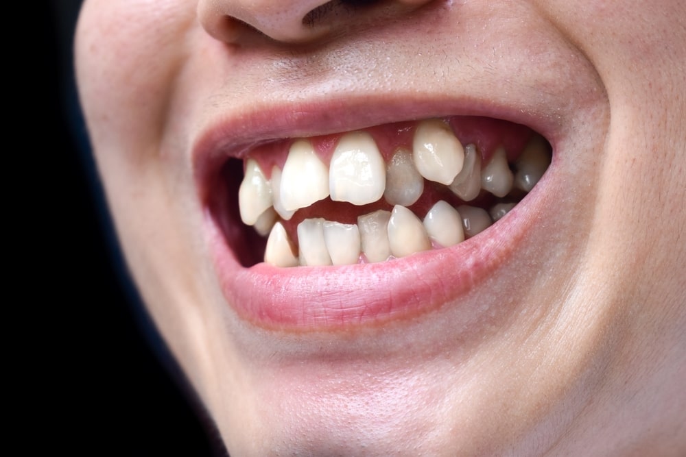 Crooked Teeth