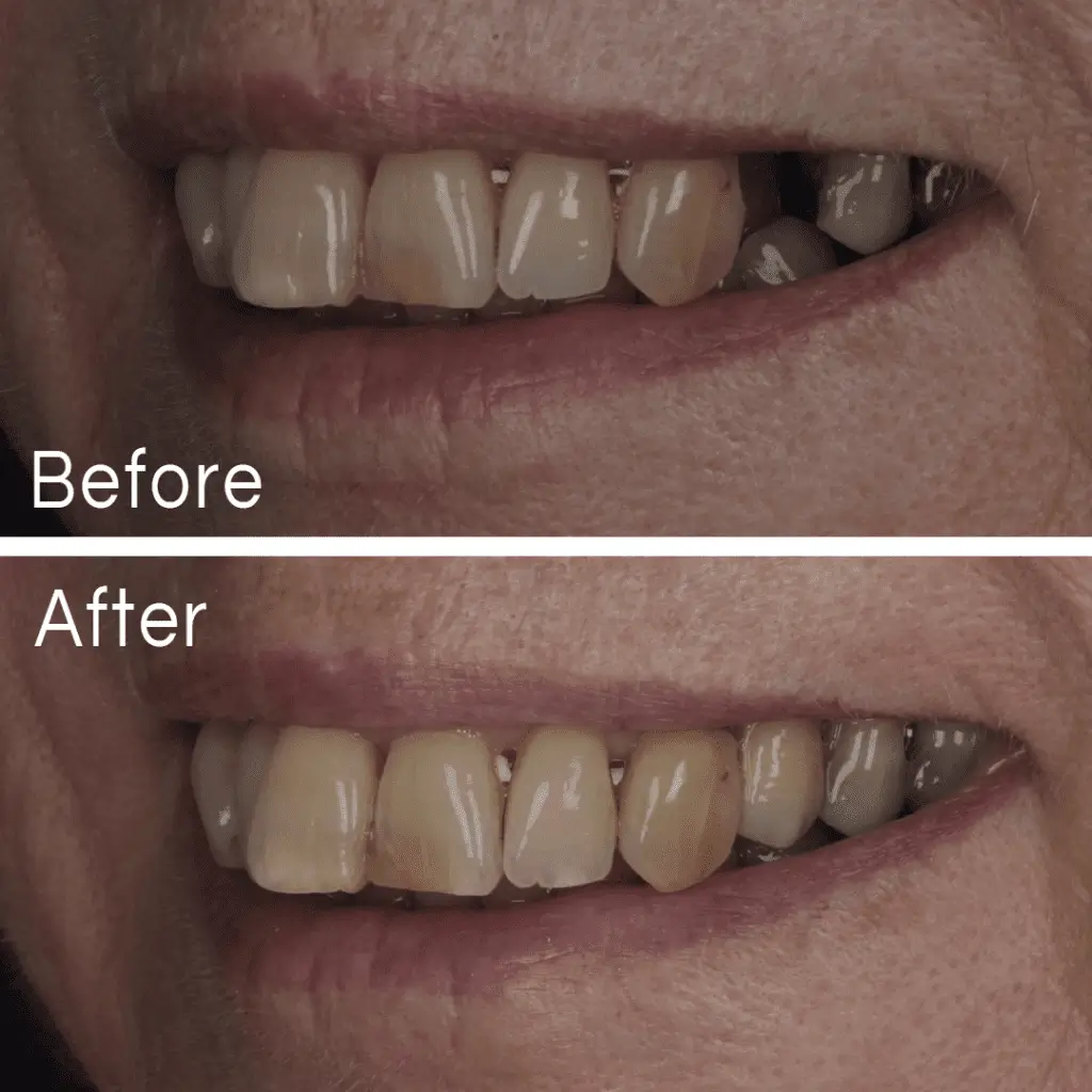 Implants Case 4 Before After