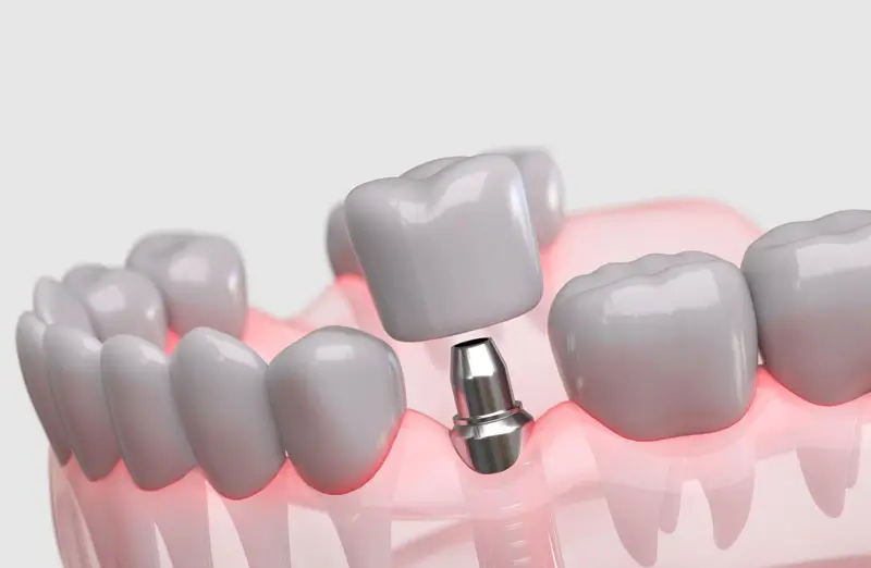 What A Dental Implant Is And How It Works What A Dental Implant Is And How It Works