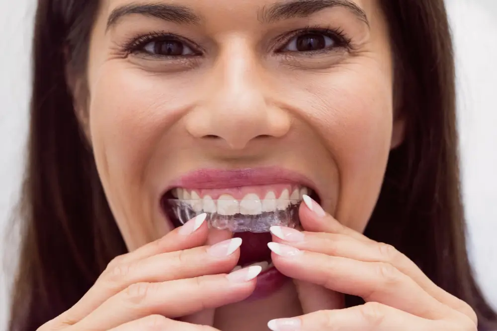 What Are Clear Aligners