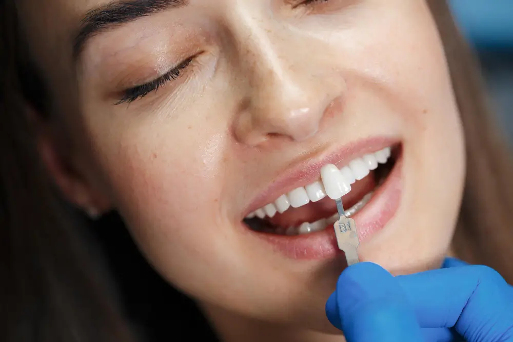 What Are Dental Veneers
