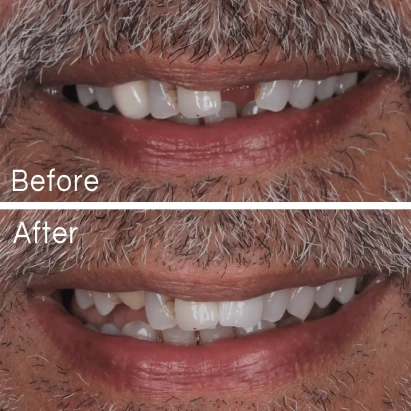 Implants Case 3 Before After
