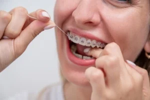 Can Adults Have Braces clean Can Adults Have Braces clean